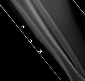 Tibial Stress Fracture